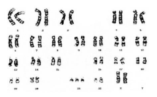 Karyotype with three copies of chromosome 21